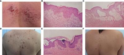 Case Report: Concurrence of Dermatomyositis and Autoimmune Blistering Diseases: Two Case Reports and a Literature Review